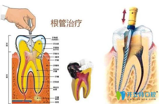 南昌安植雅口腔洪伟伟医生介绍显微根管治疗优势