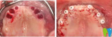 重庆齐美口腔即刻种植牙术后即刻效果