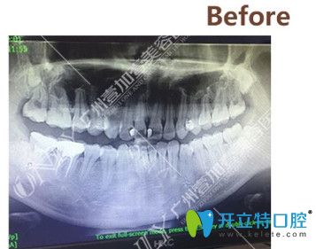 矫正前拍摄的CT