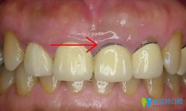 注意,烤瓷牙變成這樣就要及時拆除啦!