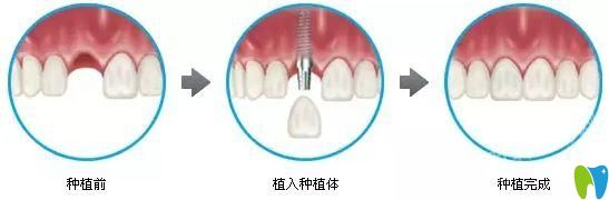 清远中大口腔曹银光科普即刻种植牙技术优势