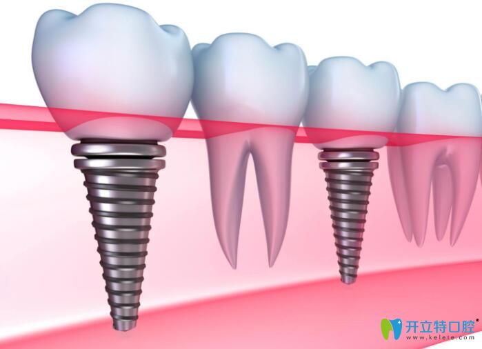 如何判断种植牙是否成功