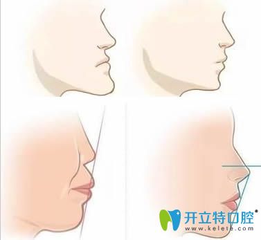 王利晖讲解正颌技术的示意图