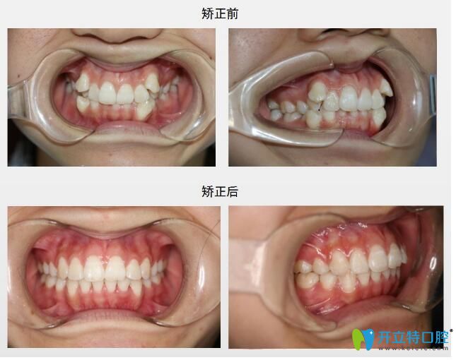 北极星口腔金属托槽矫正效果