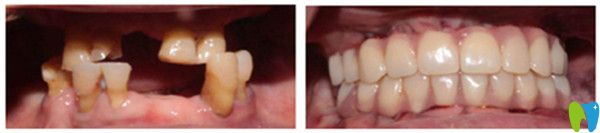 All-on-4全口种植牙前后对比图