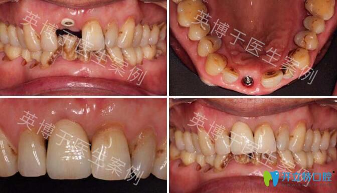 <!--<i data=20240703-sp></i>-->英博口腔种植牙好不好？杨晓飞院长真人案例来揭晓