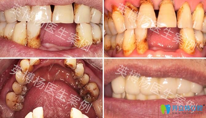 英博口腔多颗牙缺失种植案例