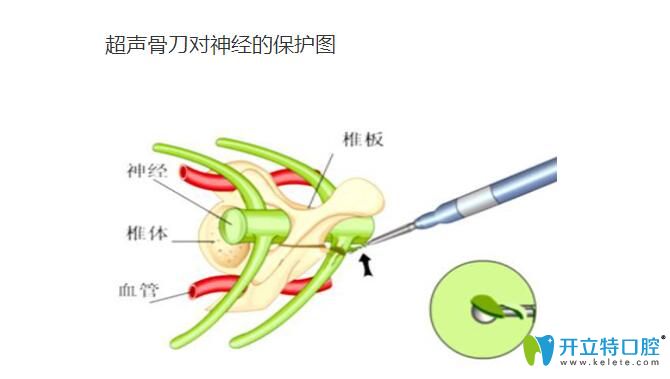 超声骨刀拔牙有什么特点