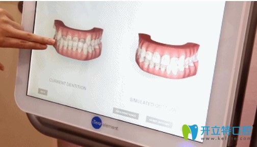 好佰年口腔矫正黑科技iTero