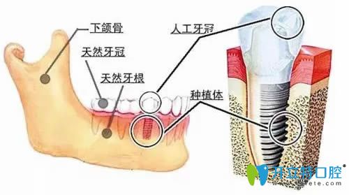 种植牙后做正畸需要避开这颗种植牙