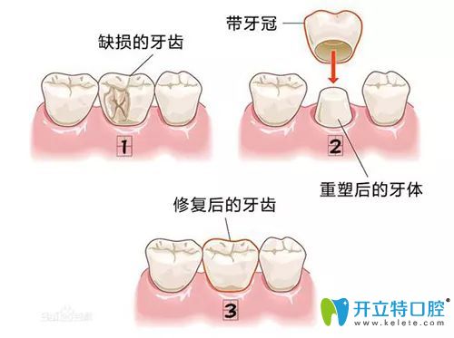 重庆维乐口腔王凤医生介绍全瓷冠修复优势