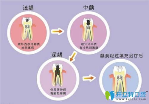 包紫雨医生科普牙体牙髓病的治疗方法