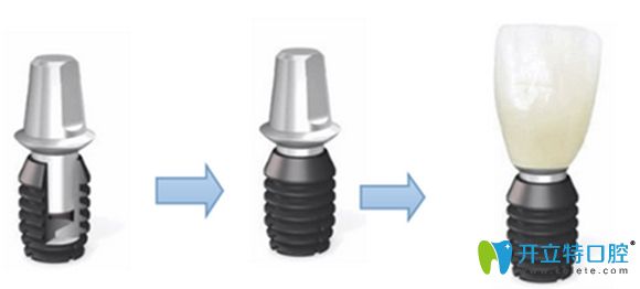 美国百康种植牙过程示意图