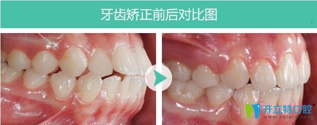 福州维乐口腔龅牙矫正案例图