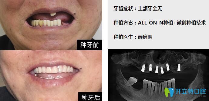 牙真人案例来揭晓【上半口牙缺失all-on-6种植牙前后照片】种植前