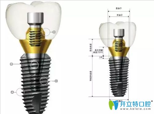 韩国登腾种植体解剖图