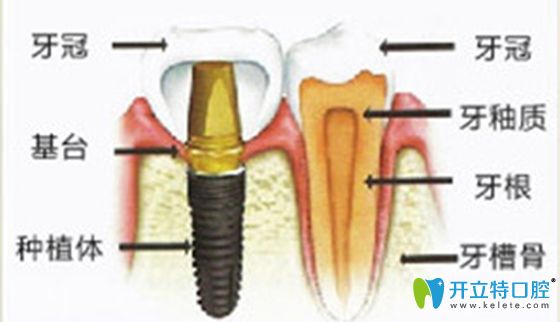 牙槽骨与种植牙图解
