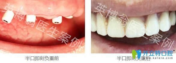 看我找上海英博口腔翁弘元花3999元做的韩国种植牙效果怎样