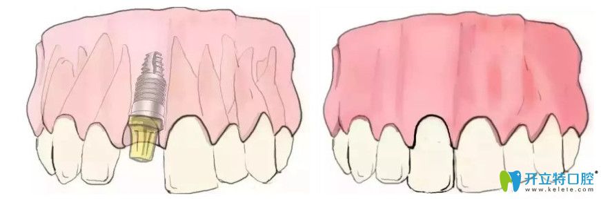 天津中诺口腔单颗义齿种植过程图示