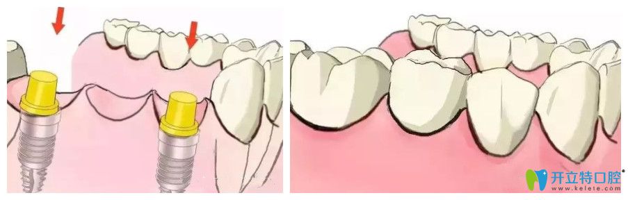 中诺口腔多颗牙种植图示