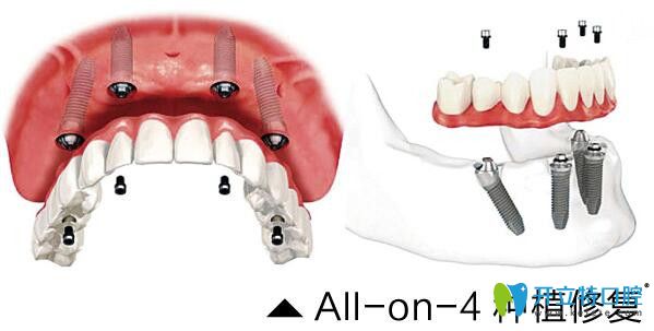 看65岁顾客在常州北极星口腔做的All-on-6半口种植牙效果好不