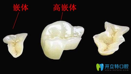 嵌体和高嵌体区别示意图