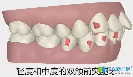 隐适美适合矫正轻度和中度的双颌前突龅牙