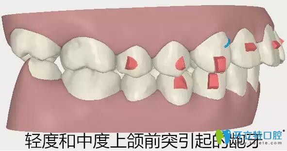 隐适美牙套适合矫正轻度和中度上颌前突的龅牙