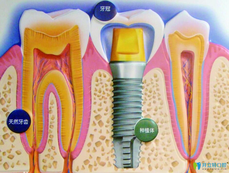 人工种植牙什么材料好?不同的材料的种植牙价格各是多少?