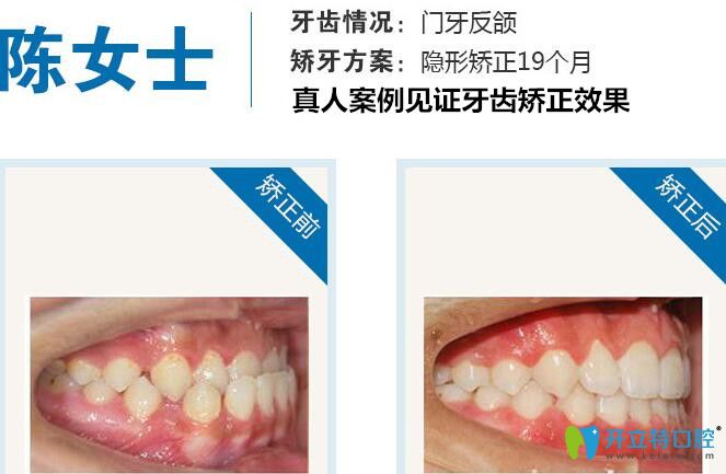 北京瑞鲨口腔地包天矫正案例