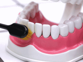 刷牙方法不对会引起牙齿楔状缺损