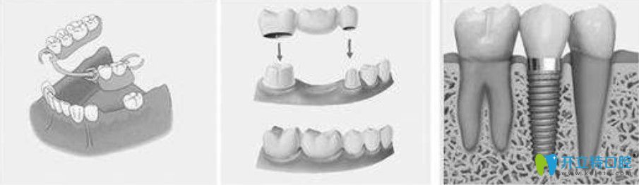 孔红梅医生告诉你种植牙、固定假牙和活动义齿相比有什么区别