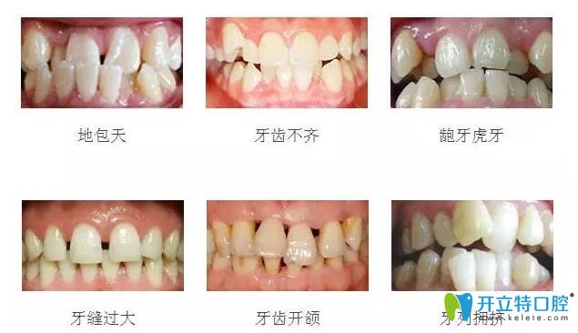 常见的几种需要做牙齿矫正的图片