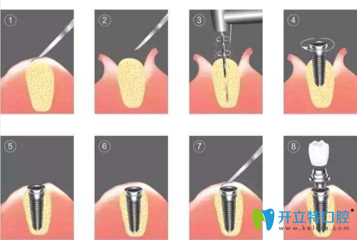 种植牙过程