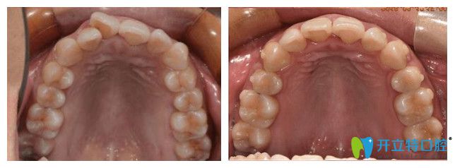 31岁的梁阿姨做的牙齿矫正的前后对比图