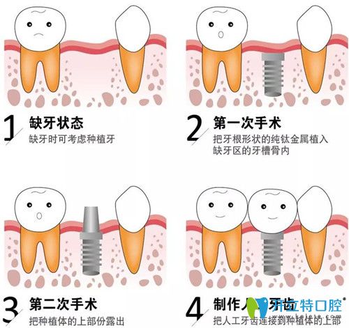 种植牙的过程是什么