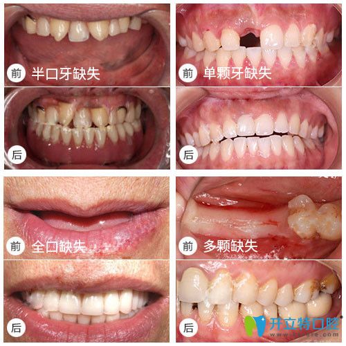 全口，半口种植牙真实案例及前后对比效果