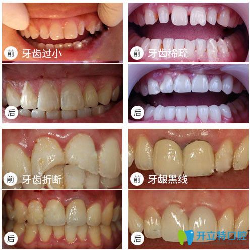 铭德口腔牙齿修复前后对比效果