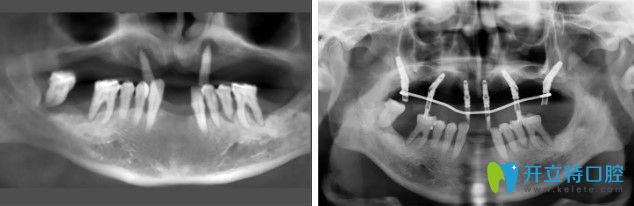 65岁王叔叔上半口牙即刻负重种植案例前后效果对比