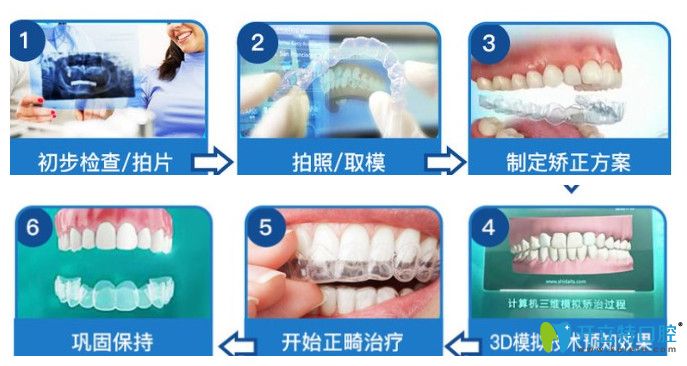根据口腔信息设计矫正方案;4,3d模拟技术预知矫正效果;5,开始正畸治疗