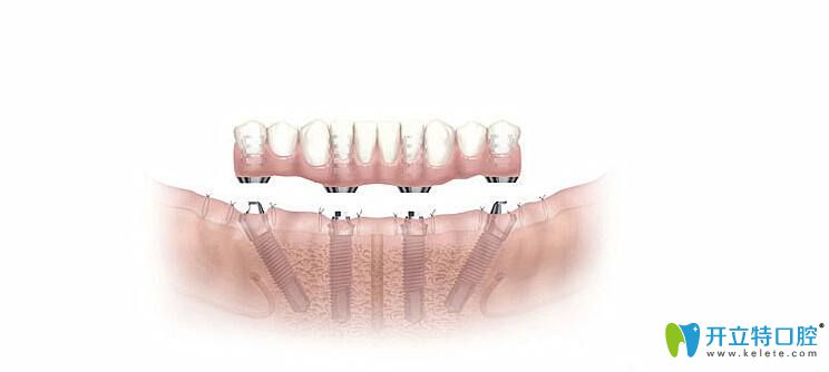 All-on-4即刻种植牙
