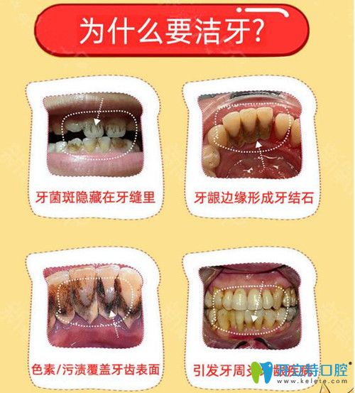 为什么要洗牙呢