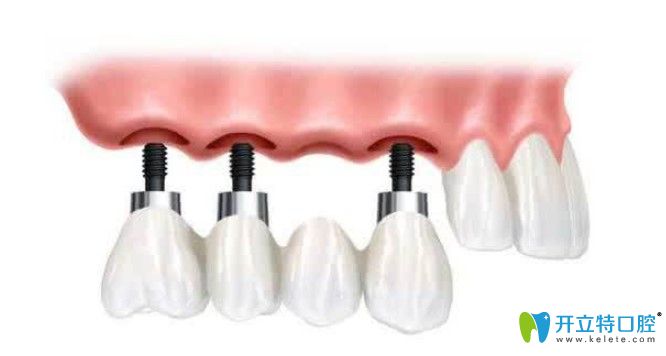 种植牙脱落是不能二次使用的