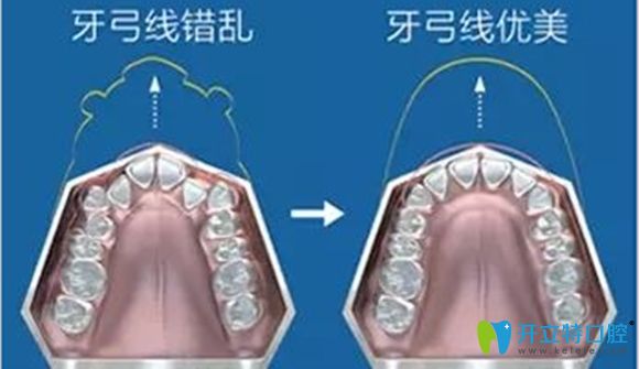 牙齿牙弓矫正前后的效果对比图