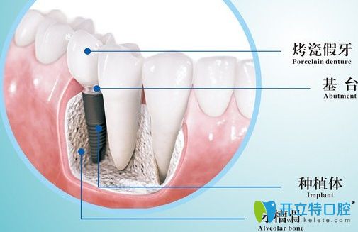 种植牙结构分布