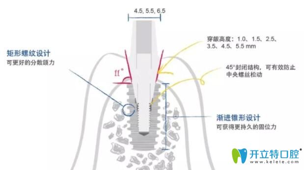 仕诺康种植体切割螺旋纹设计