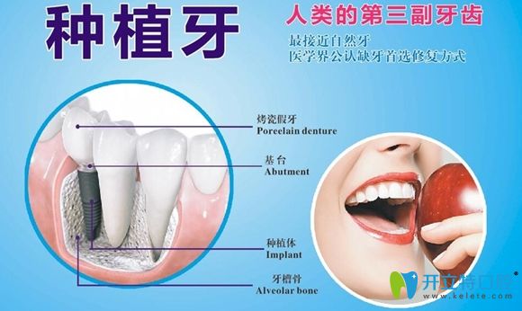 迈兔口腔半口种植牙更优惠