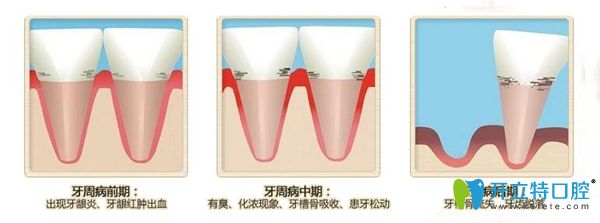 牙周病不同时期的症状