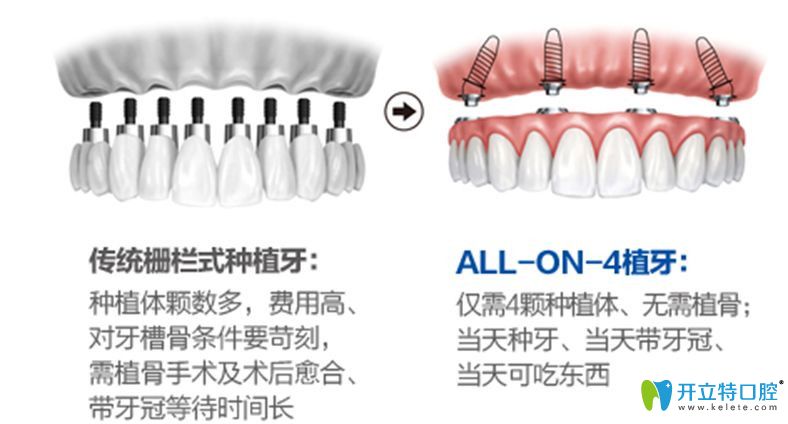 东莞好佰年All-on-4即刻负重种植技术