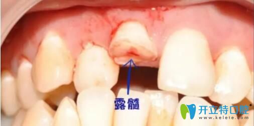 牙齿磕断露髓